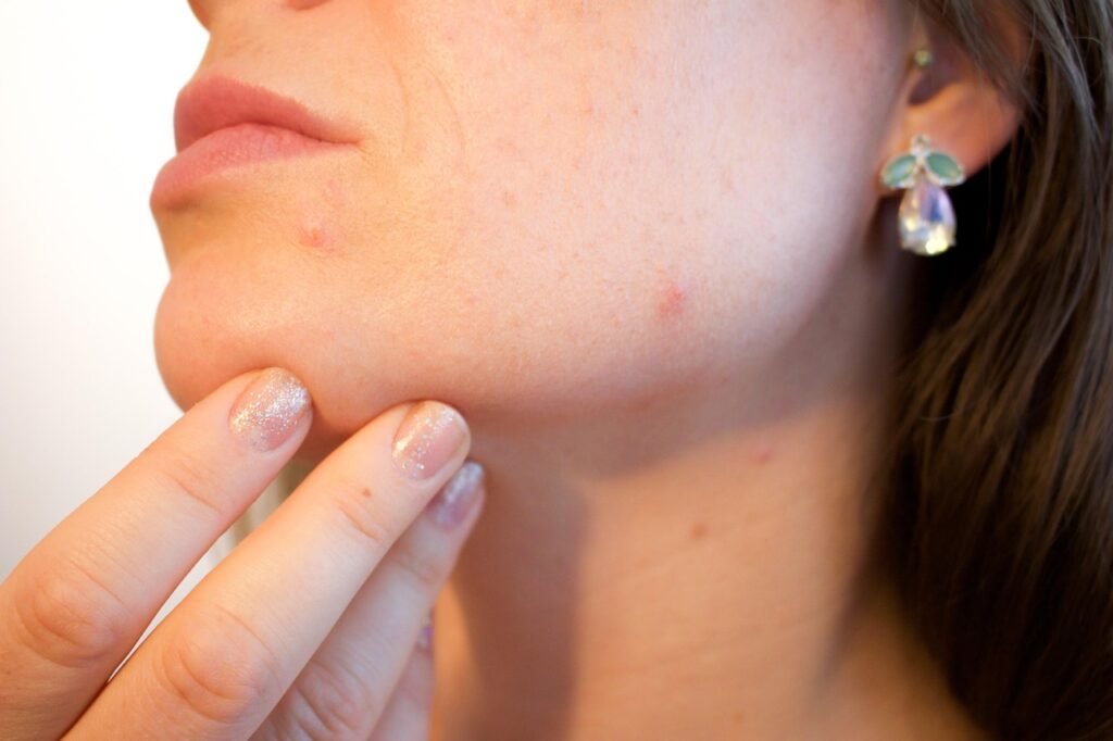 Close-up of skin showing what causes acne: clogged pores and inflamed breakouts